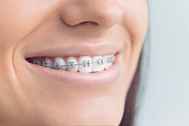 Best Traditional Braces  in Stillwater, MN